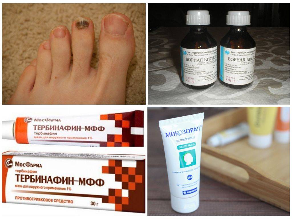 Микоз или грибок ногтей и кожи: виды, последствия отсутствия лечения