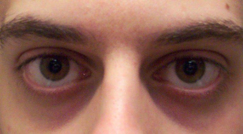 Синяки под глазами: причины, признаки, симптомы и лечение «ochkov.net»