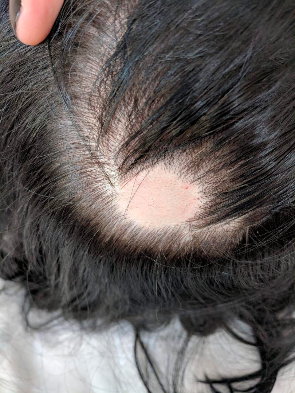 Выпадение волос после сovid-19: как лечить