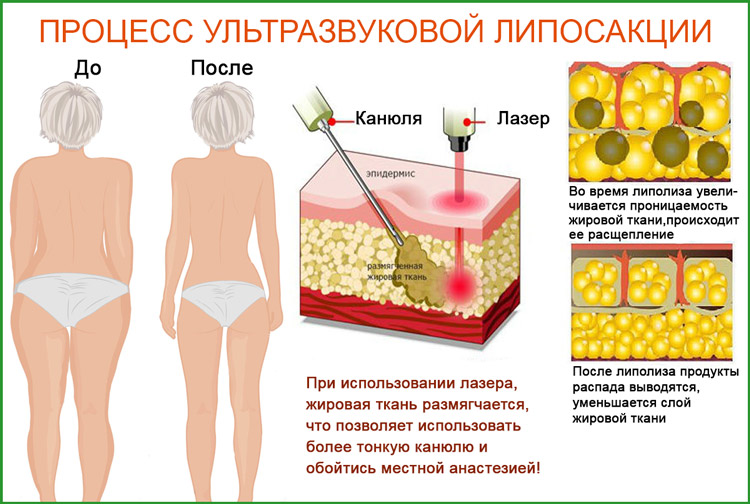 Ультразвуковая и лазерная липосакция живота, стоимость липосакции живота