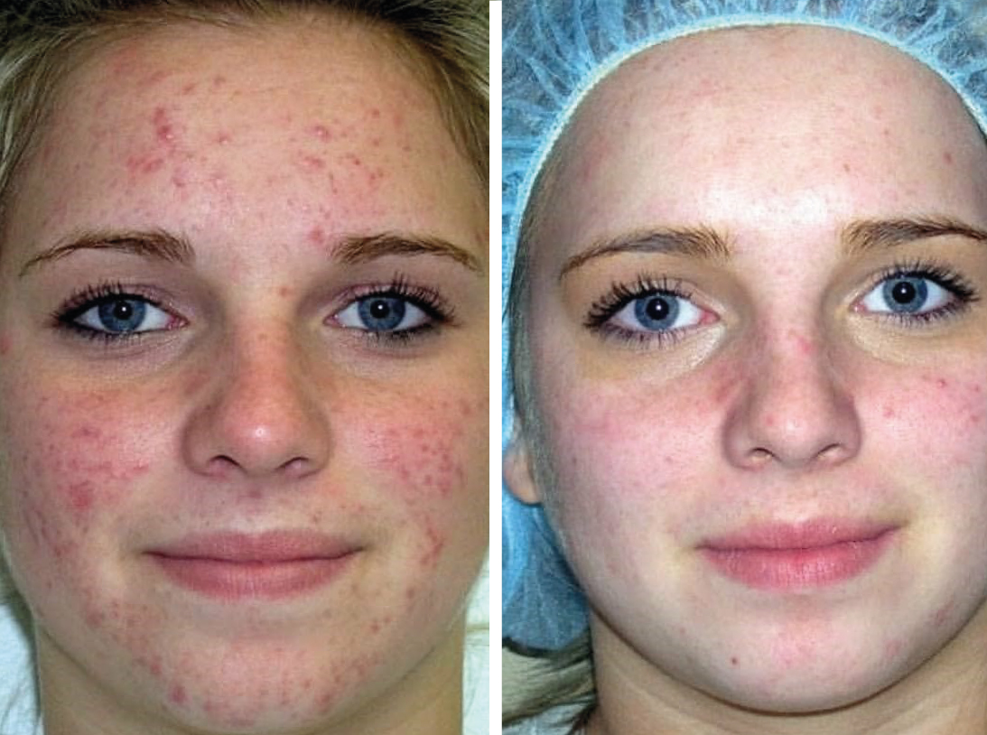 После чистки лица появились прыщи * как выглядеть кожа после процедуры?