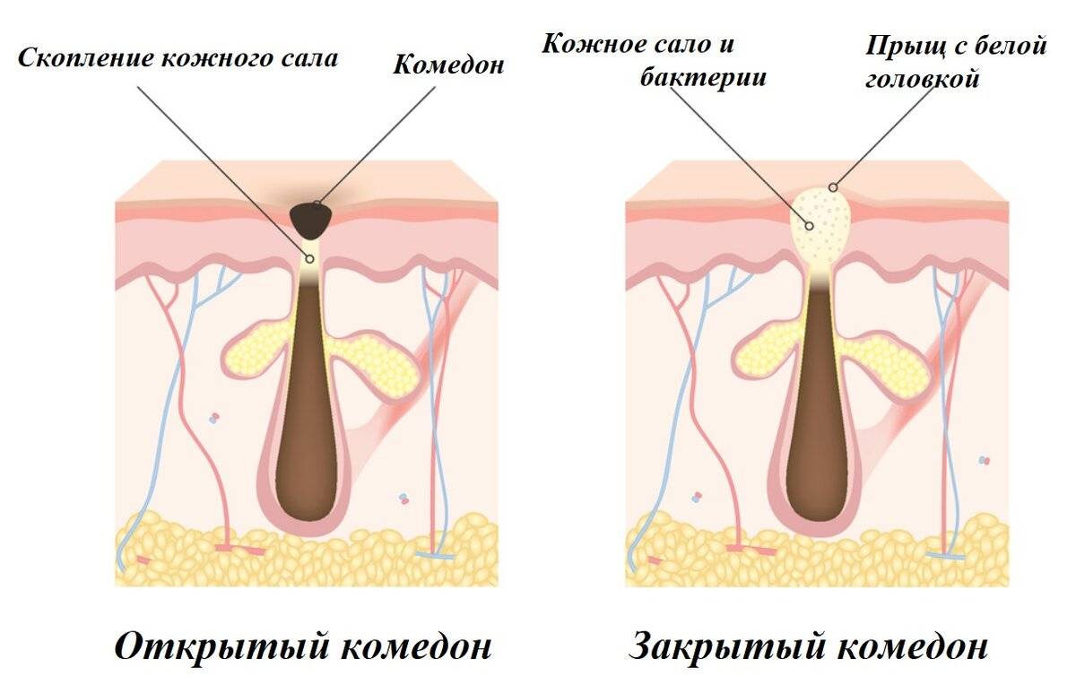 Как избавиться от комедонов на лице: различные средства и методы лечения