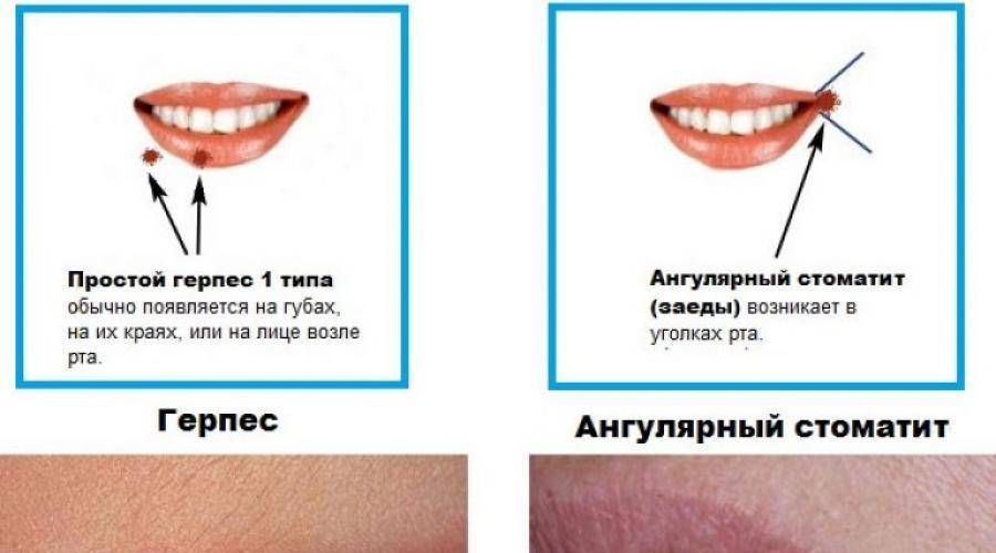 Оперативная помощь в домашних условиях при сухости и растрескивании губ
