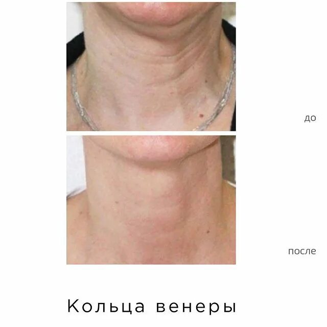 Шея и подбородок: лучшие способы восстановить контур молодости | журнал «код молодости» ????‍⚕️