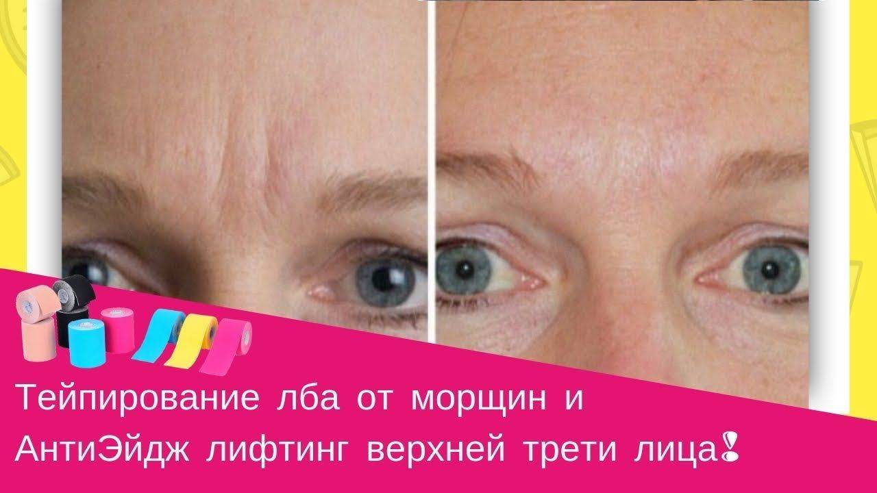 Тейпирование лица от морщин - омоложения кожи без операции!