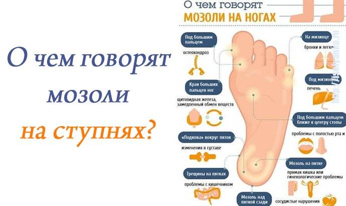 Мозоли на пальцах ног, натоптыши » лечение, удаление » харьков