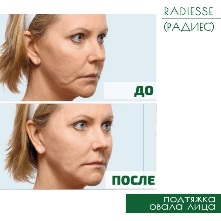 Препарат радиесс для лица в а клинике, кому показаны инъекции radiesse, результат