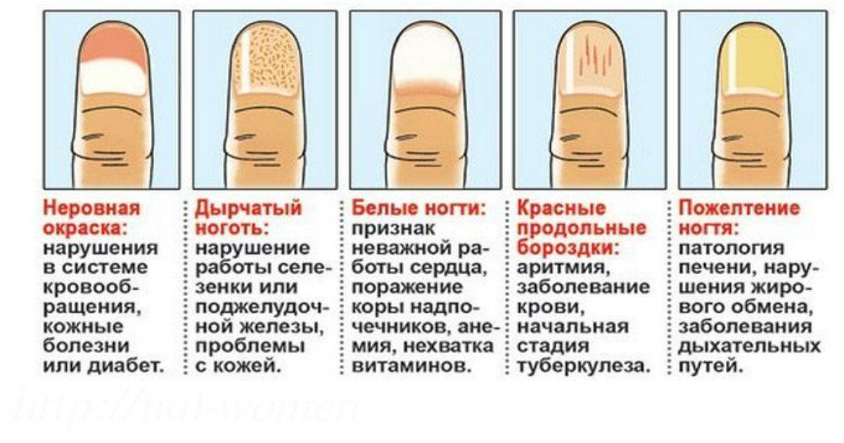Средства для лечения грибка ногтей — самые эффективные лекарства