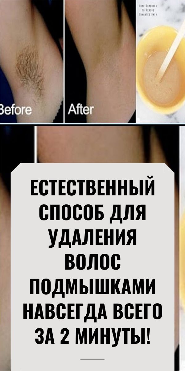 Как избавиться от волос подмышками - все способы