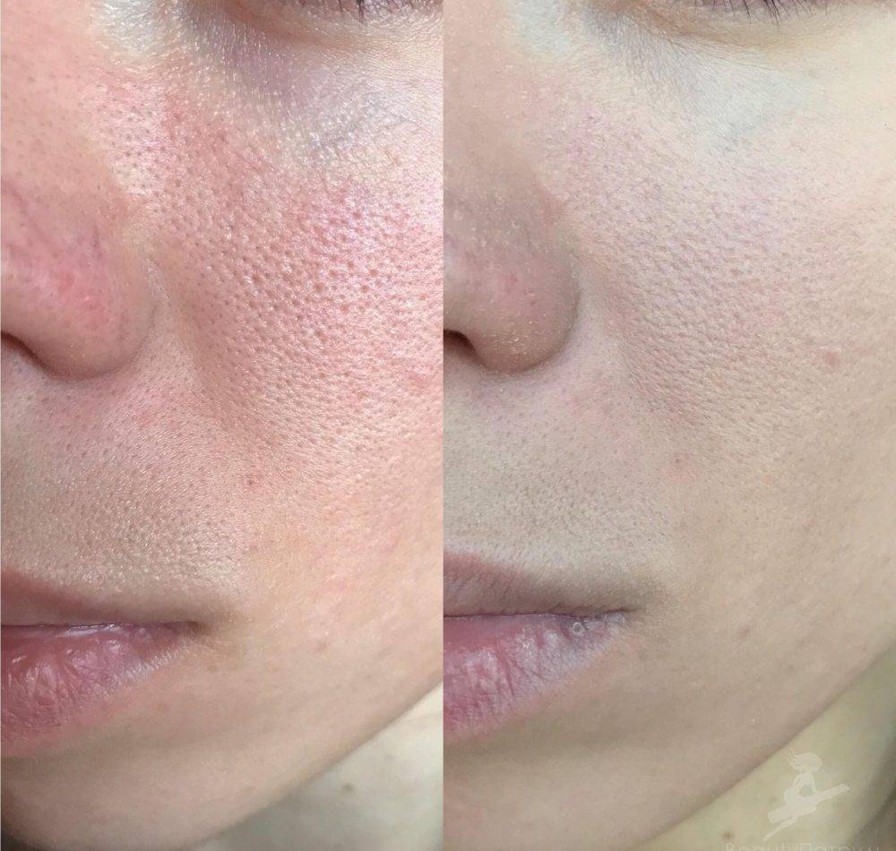 Чистка лица: как подобрать правильное лечение для вашей кожи