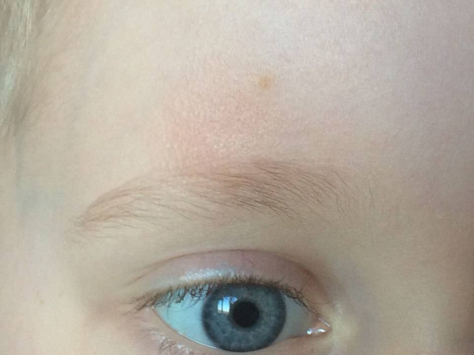 Почему у детей появляются синяки под глазами?