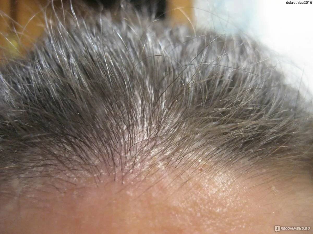 Шелушится кожа на голове у взрослого: причины, почему стала сухой, шелушения и зуда, а также что делать? лечение препаратами и народными средствами