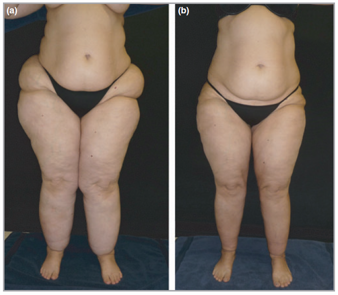 Липосакция бёдер, толстых ног у женщин. Фото до и после, цена, отзывы
