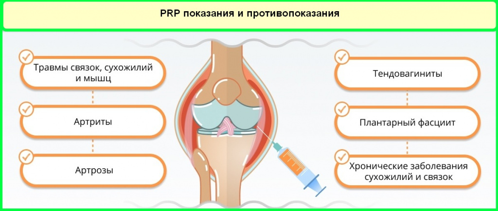 Плазмолифтинг Для Тазобедренных Суставов Отзывы Цена