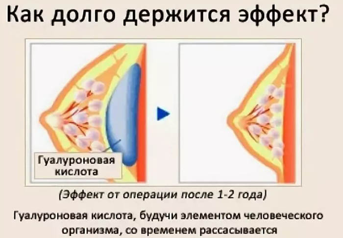 Методика Увеличения Груди Отзывы