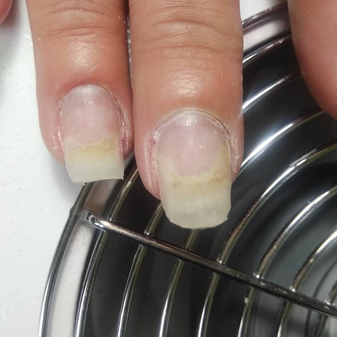 Нарощенные ногти не держатся поэтому! неожиданные причины отслаивания и как с проблемой бороться -фото — модный дизайн ногтей