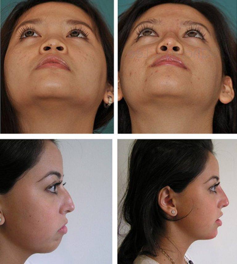 Как сделать ноздри меньше - большие или широкие ноздри | проблемы и решения