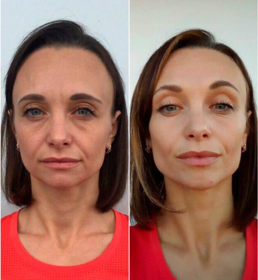 Можно ли сохранить овал лица?