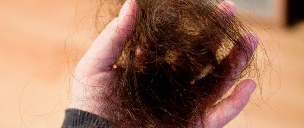 Почему выпадают волосы при туберкулезе