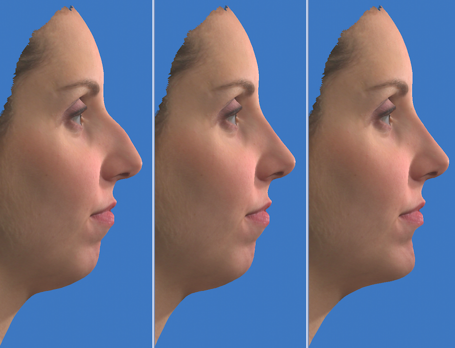 Пластика носа. Компьютерное моделирование ринопластики. Моделирование носа перед ринопластикой. Клиника нос операция