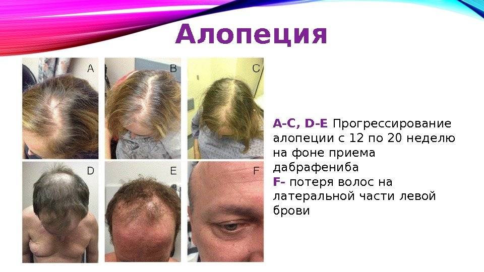 Алопеция — симптомы и способы лечения частичного или полного выпадение волос на голове в клинике целт