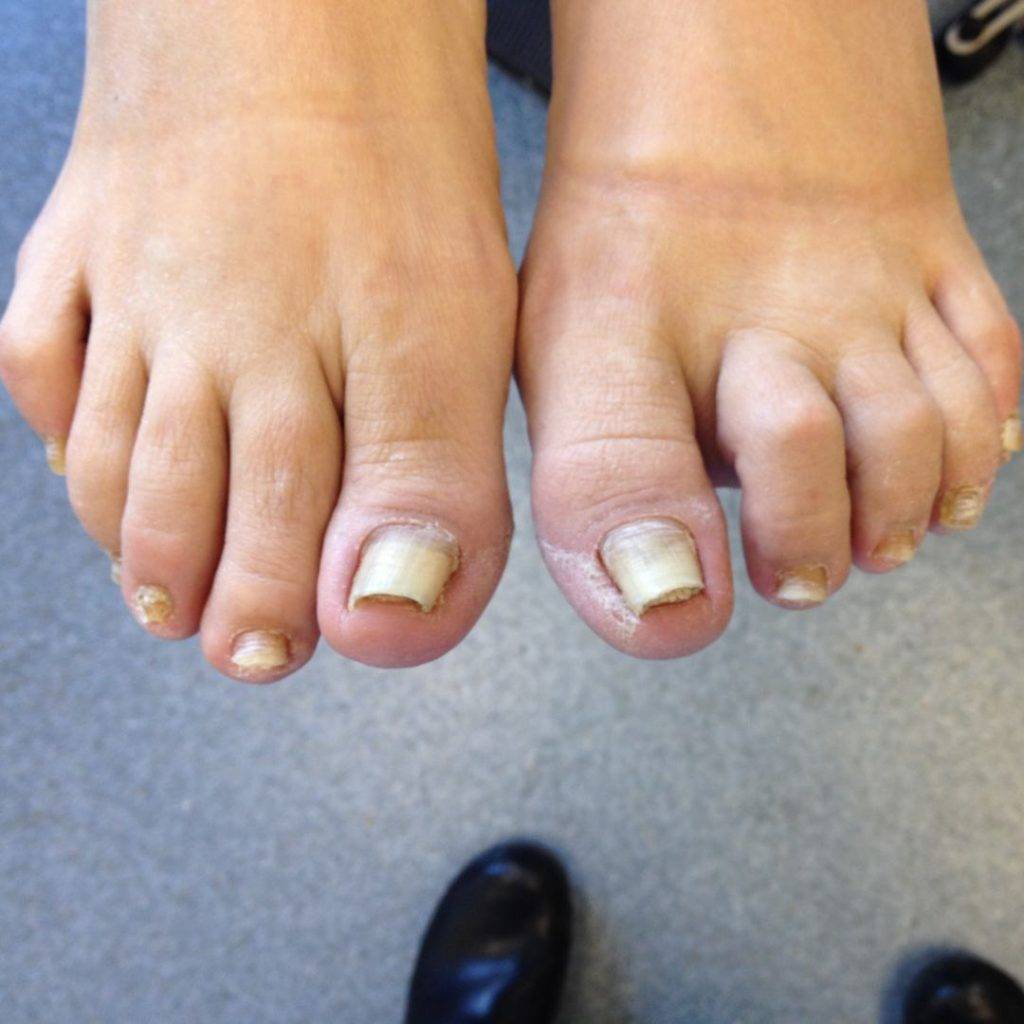 Неприрастающий ноготь | центр подологии и остеопатии татьяны красюк