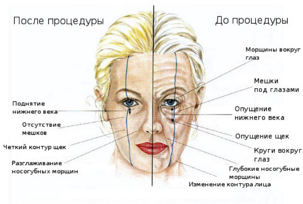 На 10 лет моложе! делаем подтяжку лица пластырем (тейпирование)