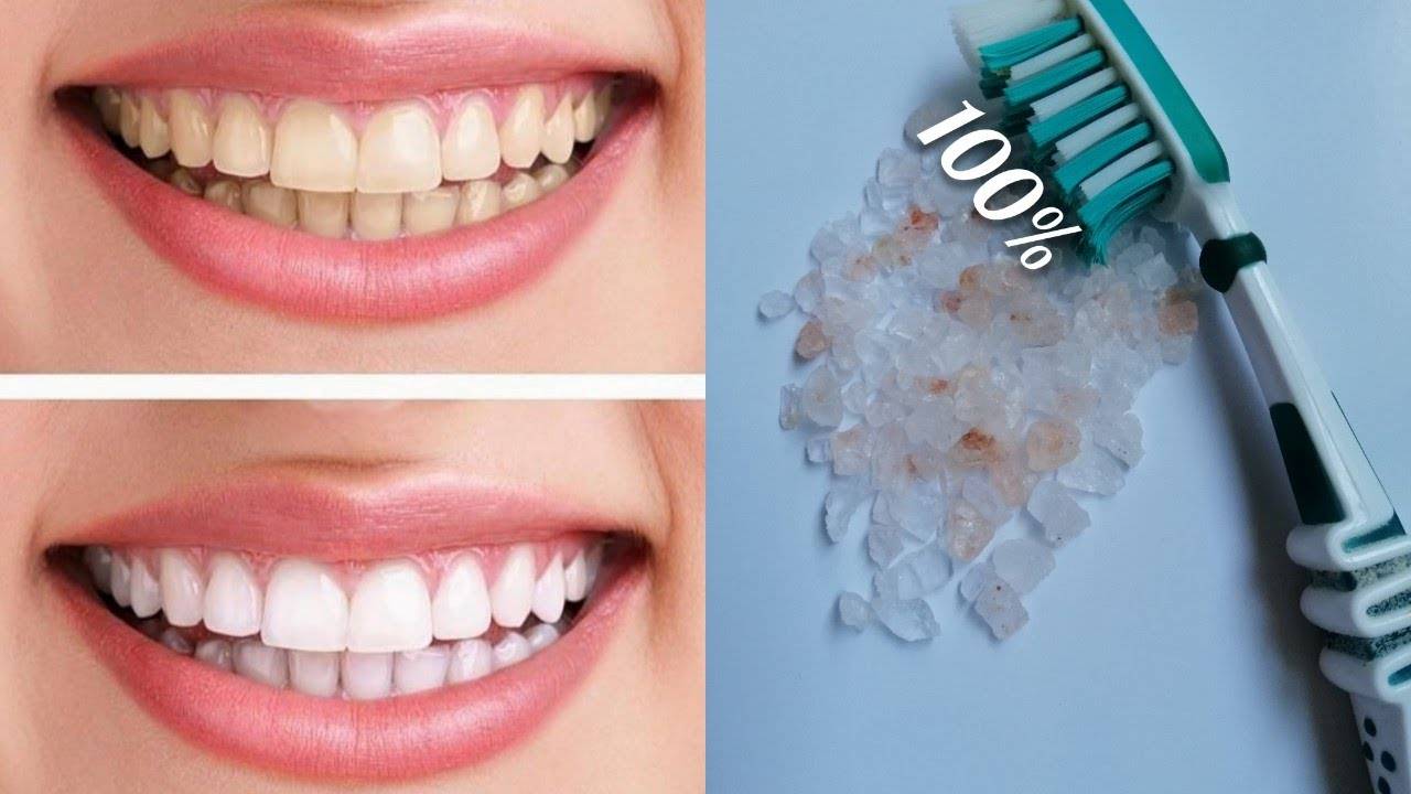 домашнее отбеливание зубов без вреда