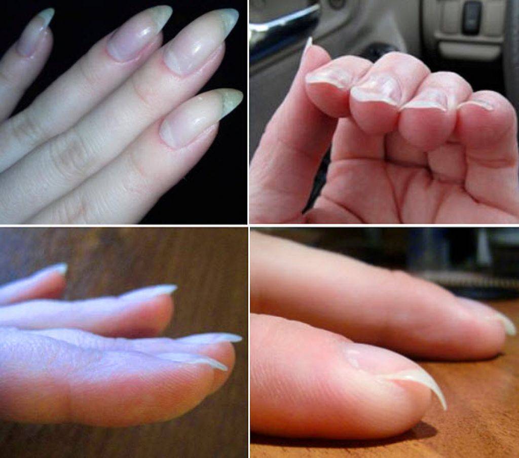 Онихорексис или трещина вдоль ногтя: почему появляется, что делать?