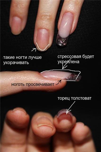 Онихолизис ногтей на руках: лечение, препараты, отзывы – эл клиника