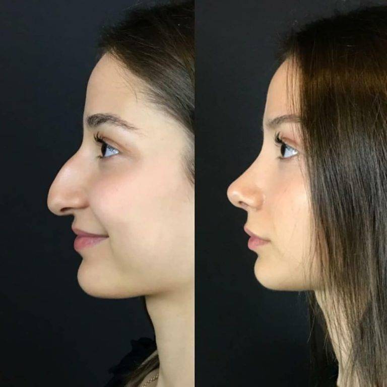 Ринопластика кончика носа. отчет пациентки