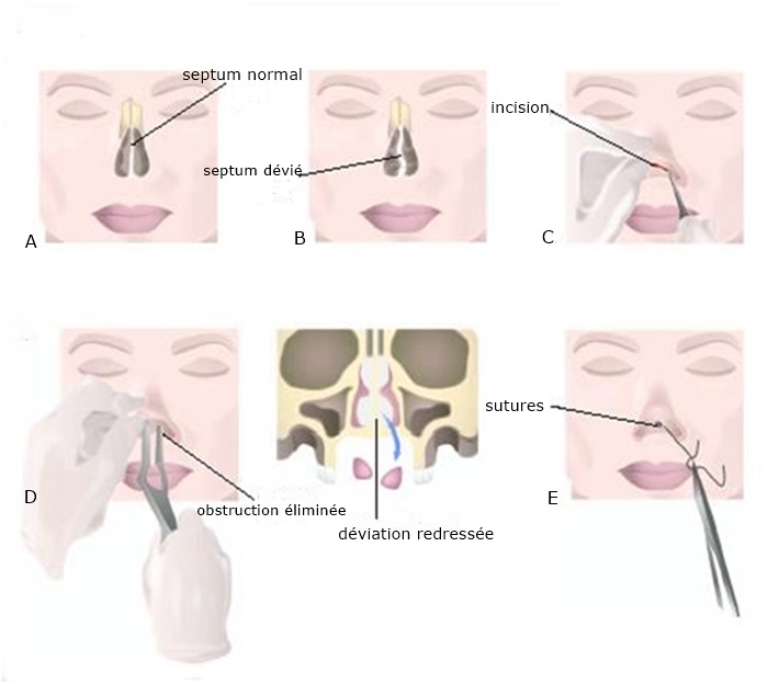 Операция по исправлению носовой перегородки или септопластика | лор боклин а. к.