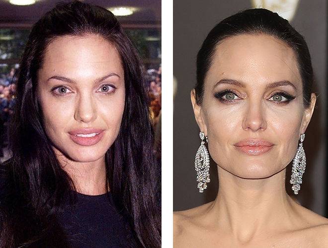 Анджелина джоли после операции: фото до и после пластики