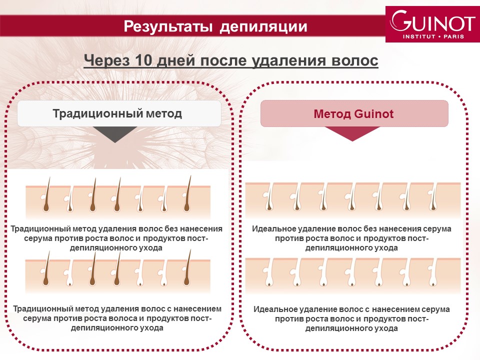 Зоны бикини схема депиляции