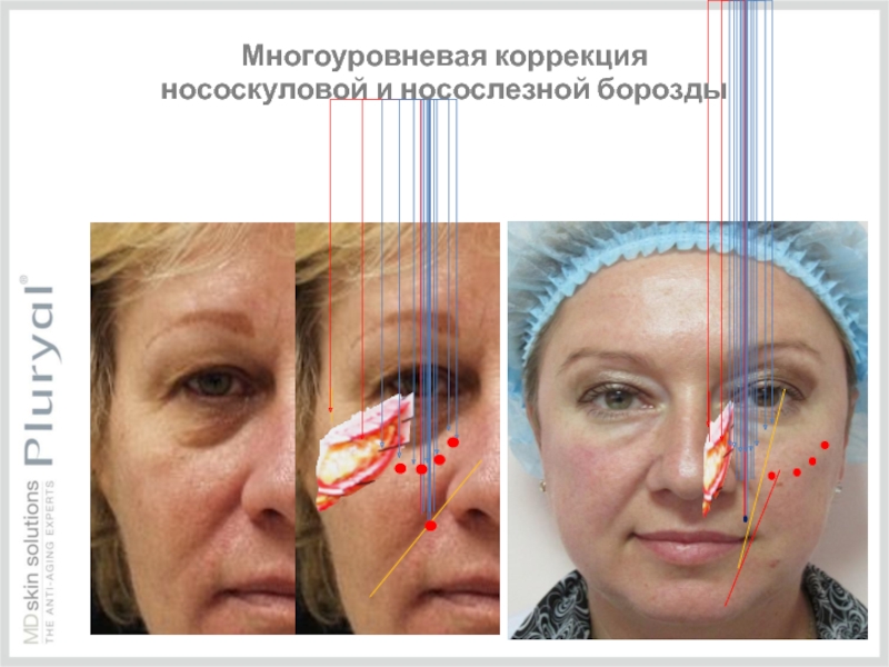 Контурная пластика носогубных складок в санкт-петербурге | клиника бионика