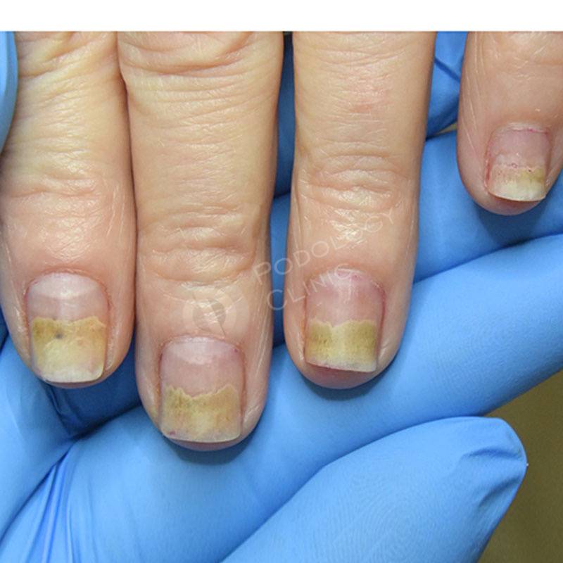 Чем лечить грибок ногтей на руках в домашних условиях: топ-20 рецептов