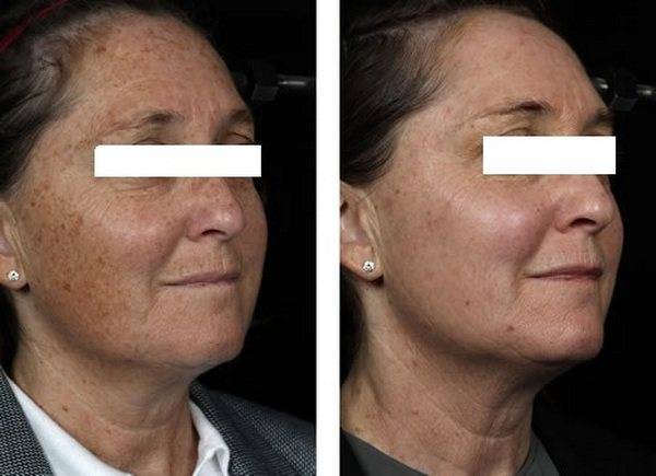 Что такое фотостарение кожи лица
