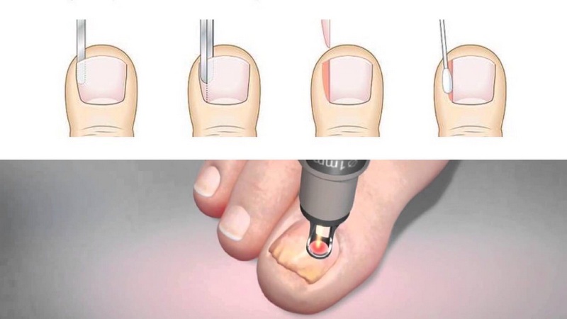 Кмн — вросший ноготь, вросший ноготь лечение, как лечить вросший ноготь, лечение вросшего ногтя, удаление вросшего ногтя, нагноение вросшего ногтя, пластика вросшего ногтя, перевязка вросшего ногтя, мазь для вросшего ногтя
