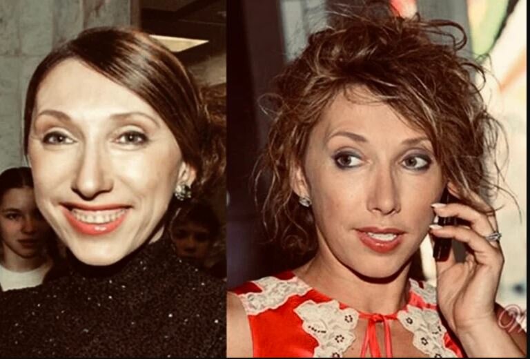 Российские знаменитости до и после пластики фото