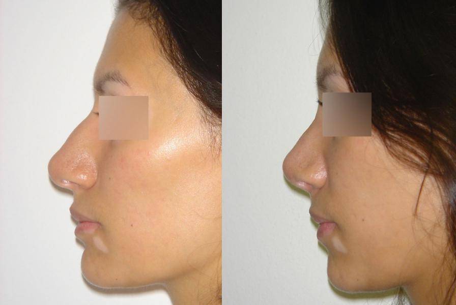 Нос с горбинкой – причины косметического дефекта, способы коррекции