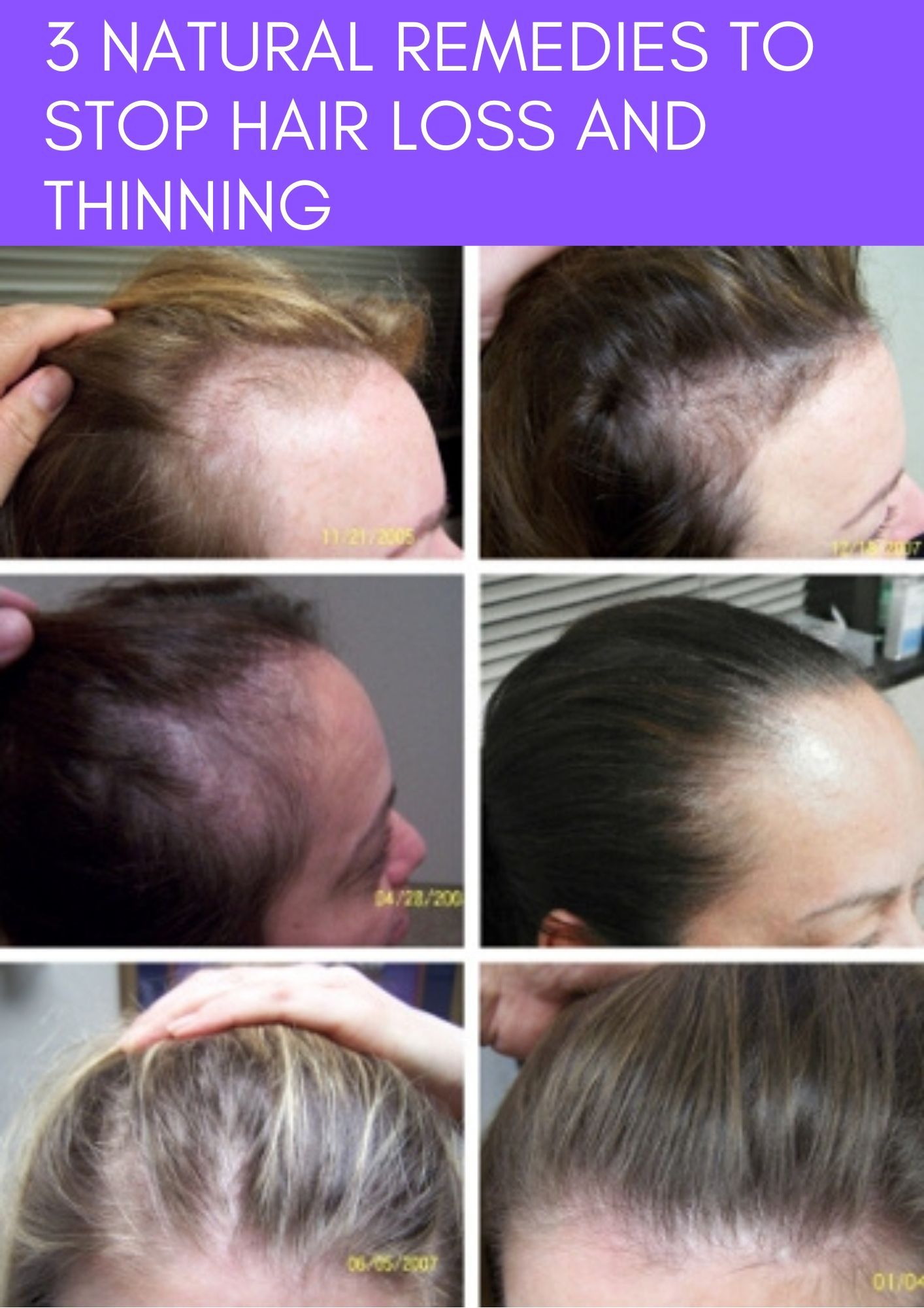 Выпадение волос во время и после беременности — норма ли это? • центр гинекологии в санкт-петербурге