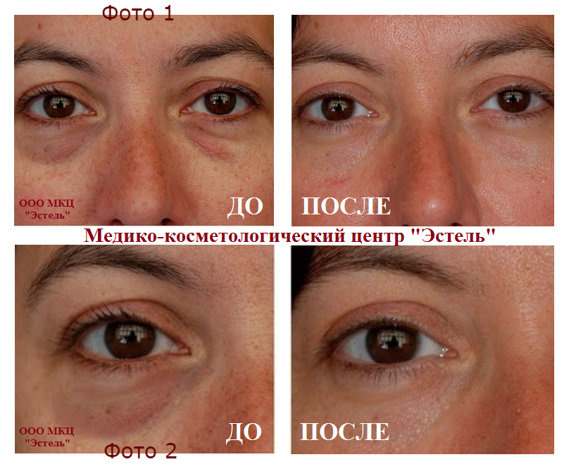 Мезо глаза отзывы. Мезотерапия кожи вокруг глаз. Мезотерапия от темных кругов под глазами.