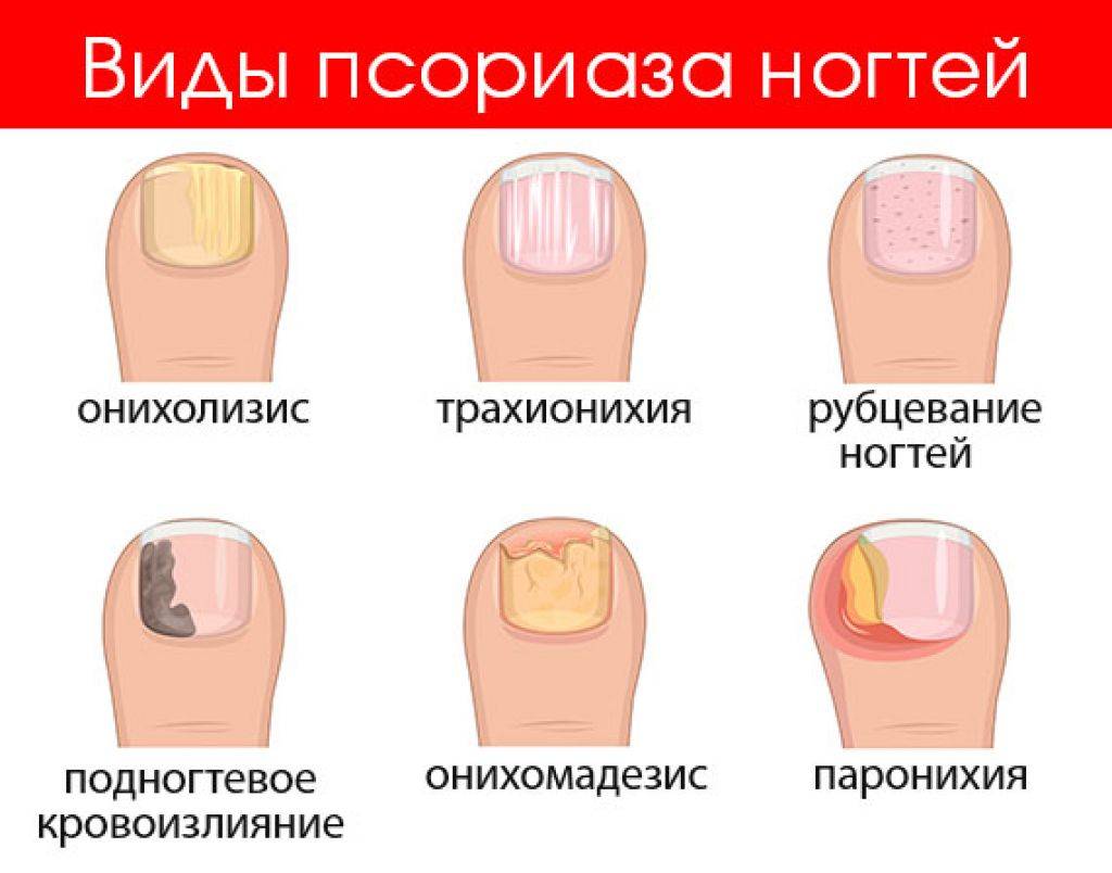 Грибок ногтей на ногах: лечение, стадии, причины