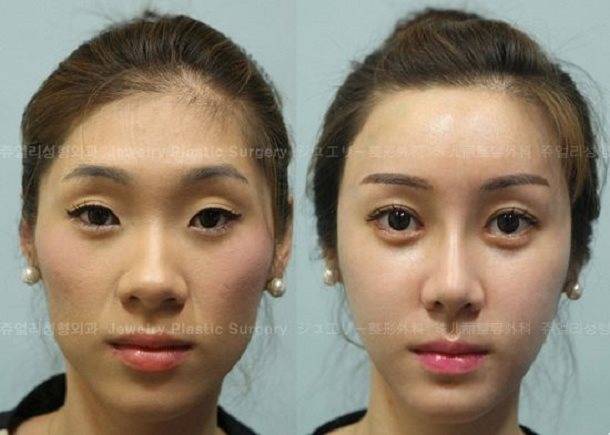 Операция по увеличению глаз: технология проведения, описание, эффект, фото до и после