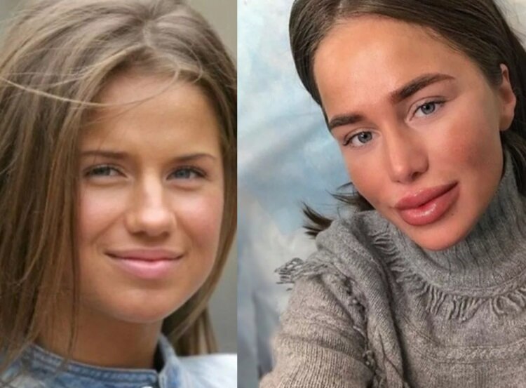 Алекса: пластика певицы, результаты для носа, губ до и после | marykay-4u.ru