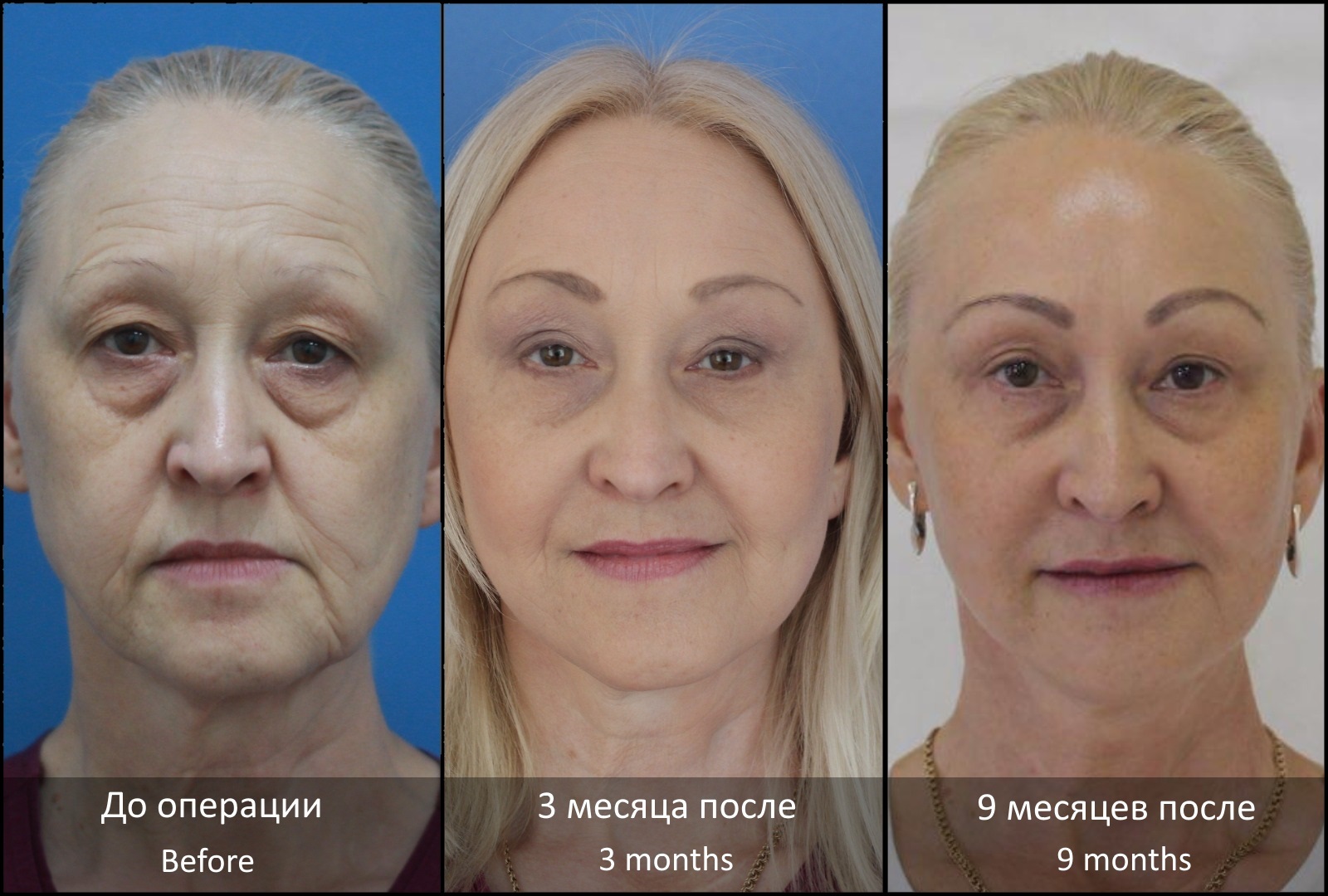 Круговая подтяжка лица: как проходит операция, отзывы, видео, реабилитация, фото до и после