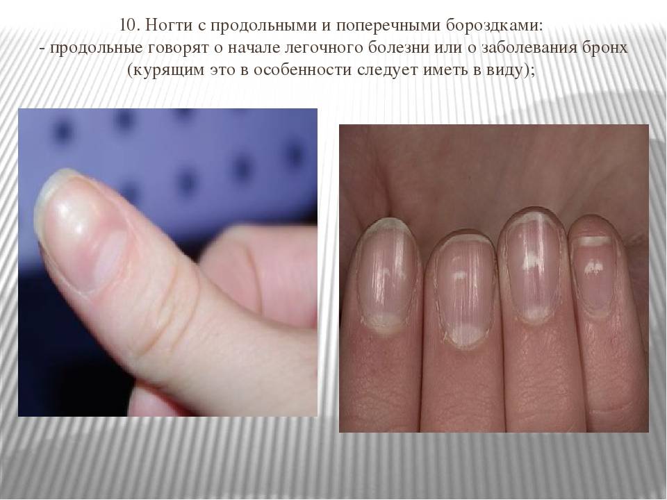 Полосы на ногтях - продольные или поперечные, причины появления, диагностика, методы лечения и профилактика