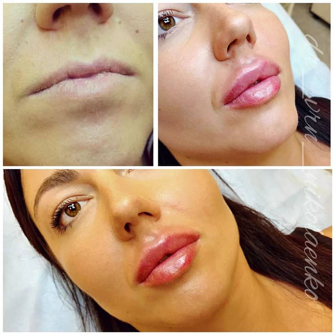 Увеличение губ: последствия и осложнения, как избежать при применении гиалуроновой кислоты - клиника красоты bellezza киев
