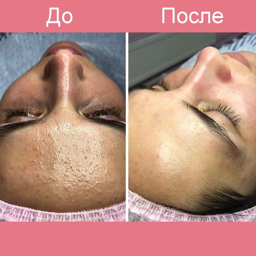 Миндальный пилинг для лица: топ эффективного ухода за кожей