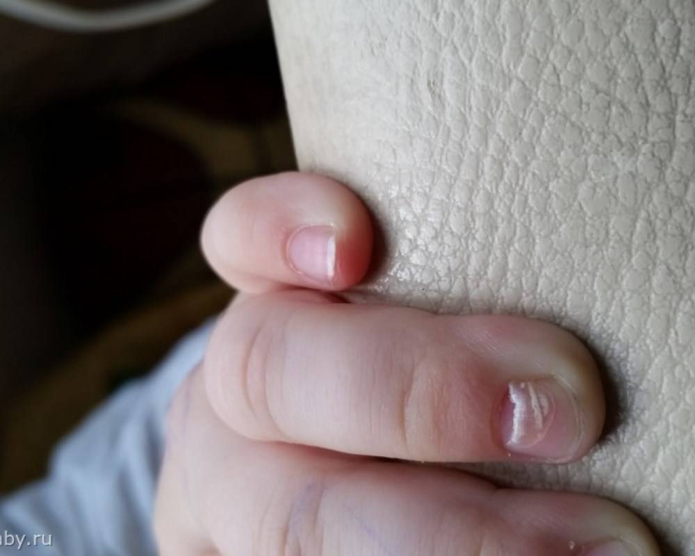 У ребенка слоятся ногти на ногах и на руках: советы комаровского